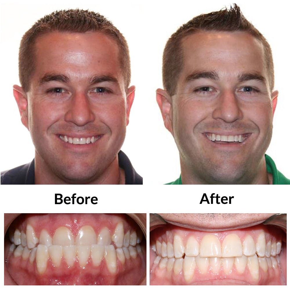 Invisalign Before and After Photo