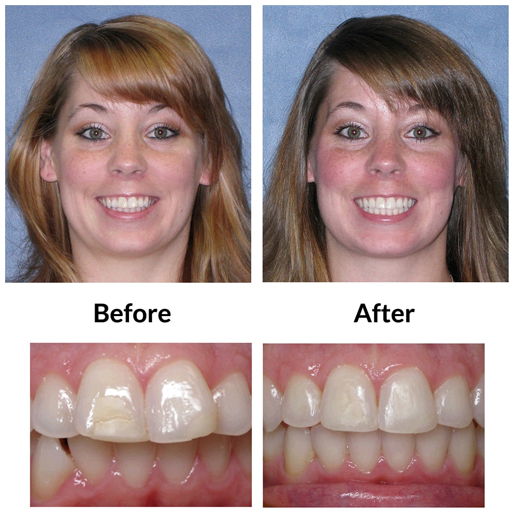 Invisalign Before and After Photo 3