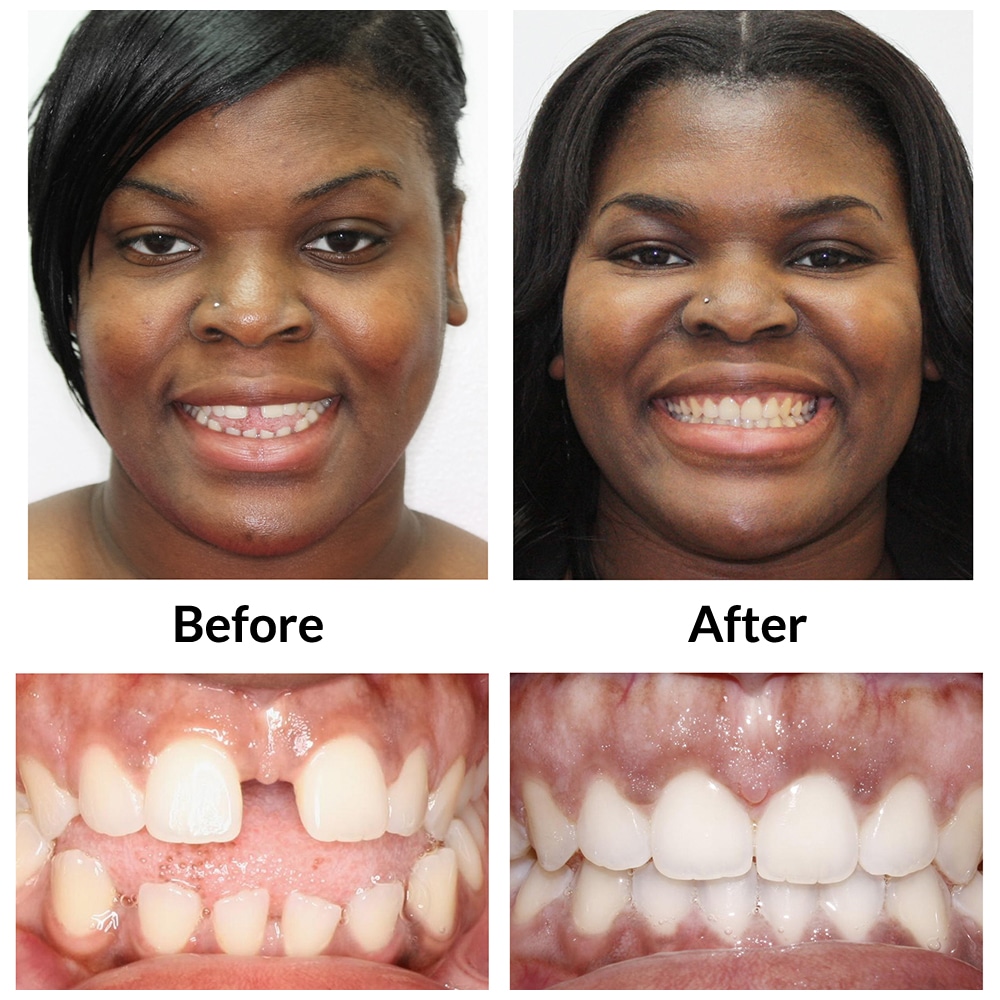 Invisalign Before and After Photo 2