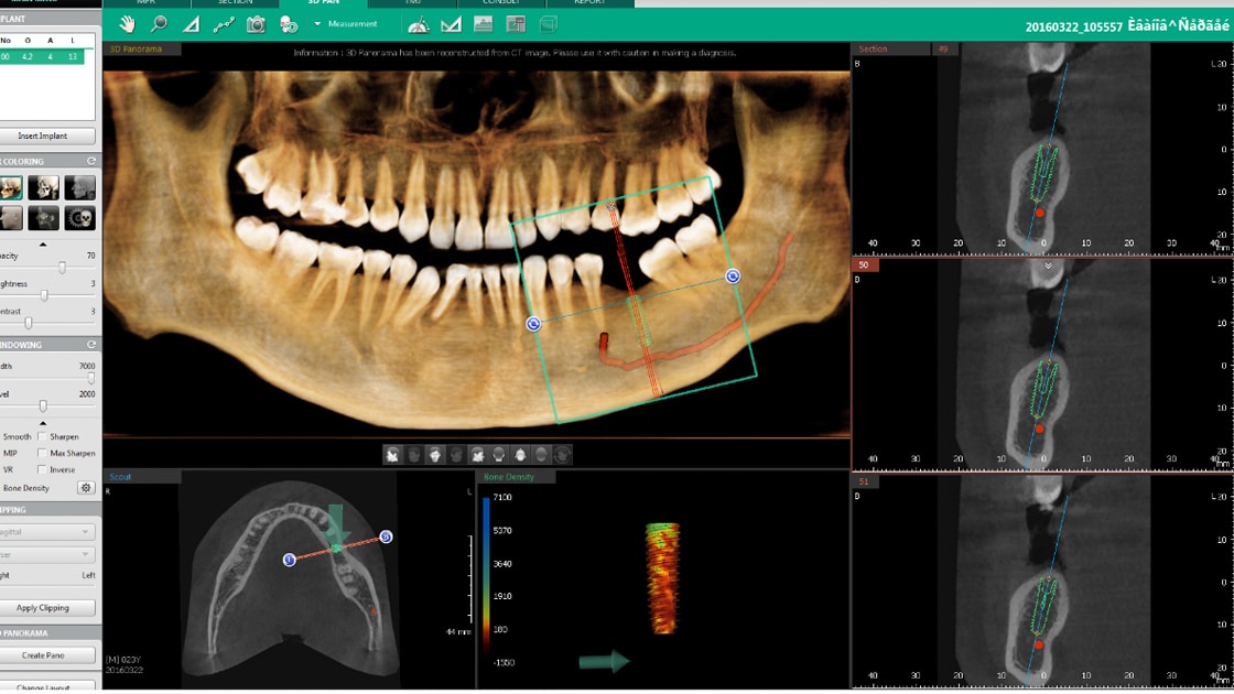 Photo of Dental Implant Placement