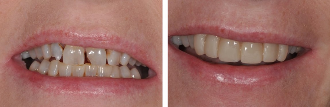 Before / After Composite #3