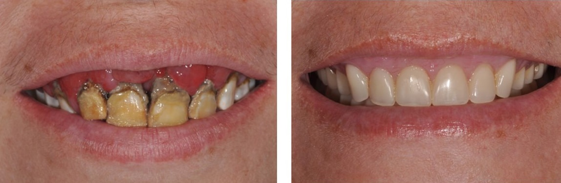 Before / After Dentures #1
