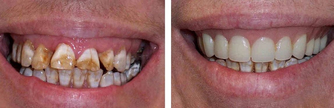 Before / After Dentures #2