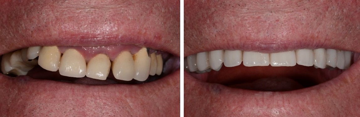 Before / After Dentures #3
