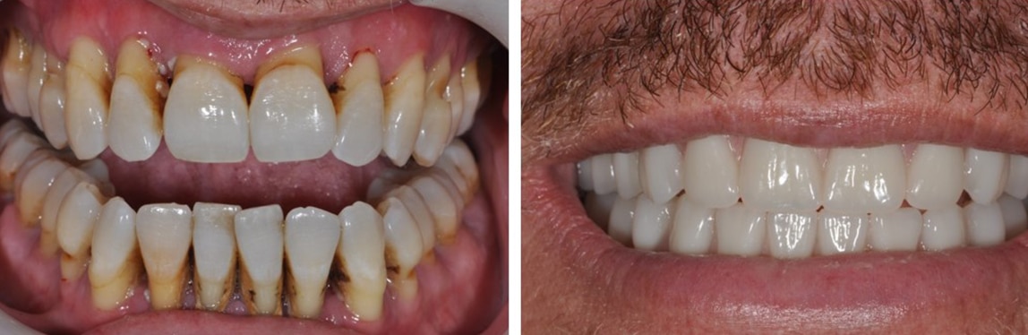 Before / After Dentures #4