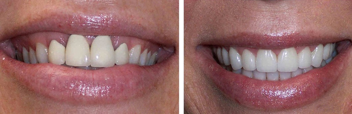 Before / After Full Mouth Rehab #11