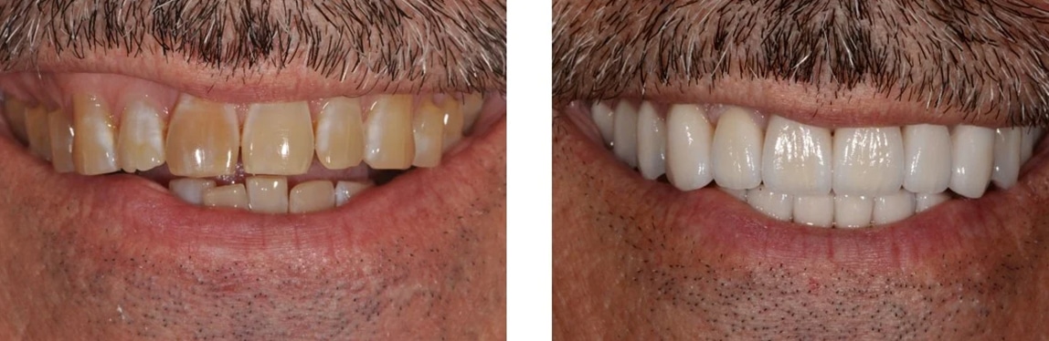 Before / After Full Mouth Rehab #12