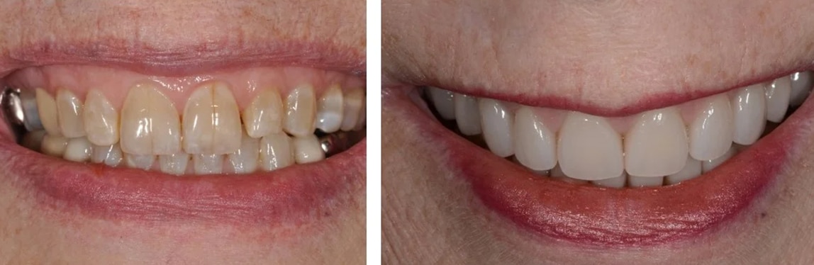 Before / After Full Mouth Rehab #14