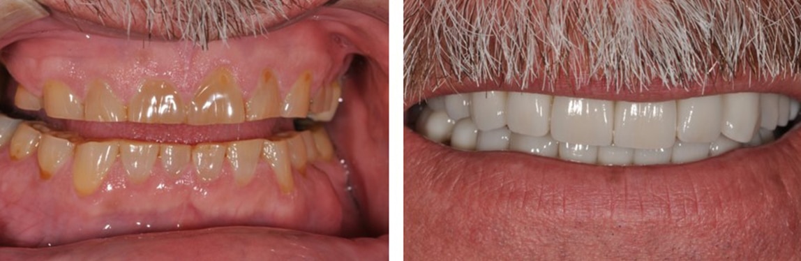 Before / After Full Mouth Rehab #3