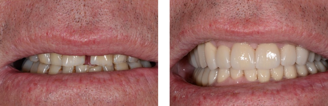 Before / After Full Mouth Rehab #4