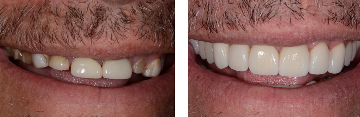 Before / After Full Mouth Rehab #5