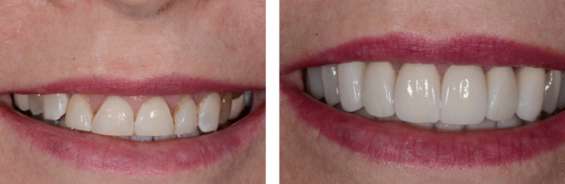 Before / After Full Mouth Rehab #7