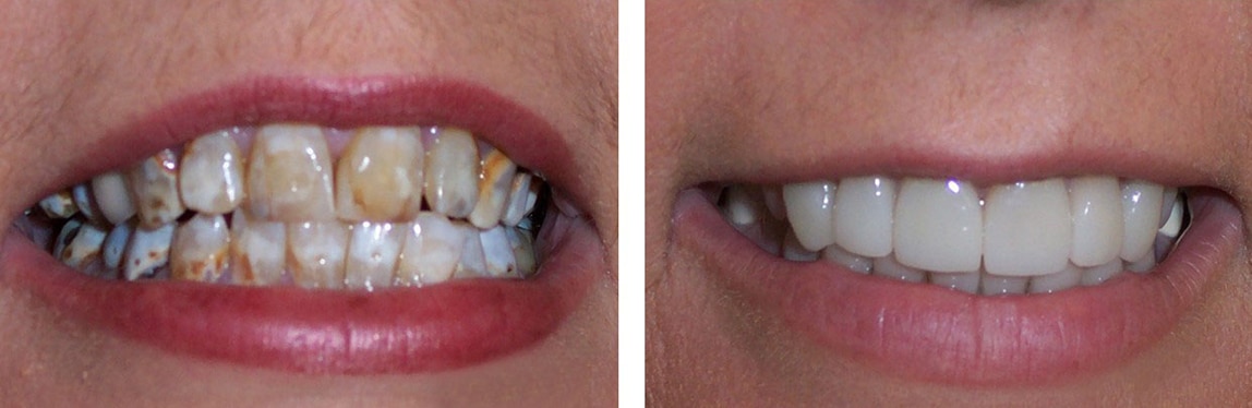 Before / After Full Mouth Rehab #8