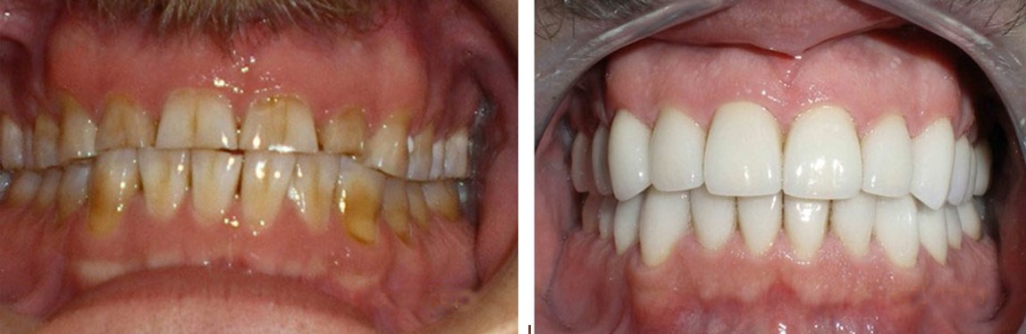 Before / After Full Mouth Rehab #9