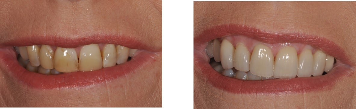 Before / After Veneers #1