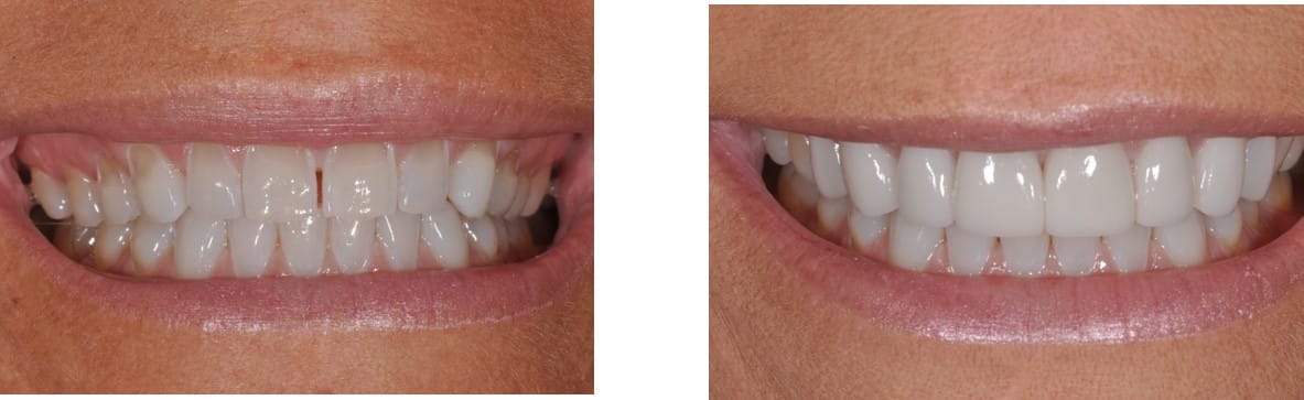 Before / After Veneers #12