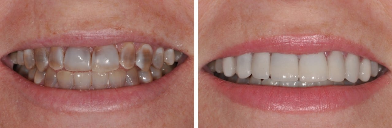 Before / After Veneers #13