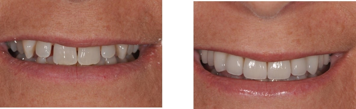 Before / After Veneers #14