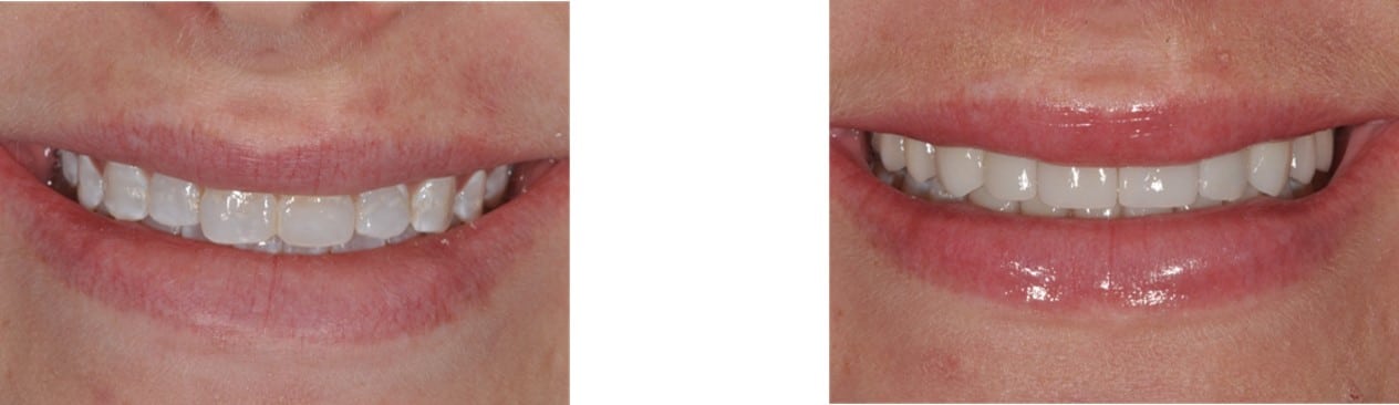 Before / After Veneers #15