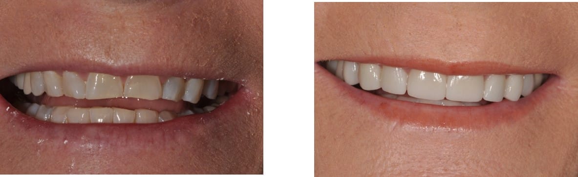 Before / After Veneers #16