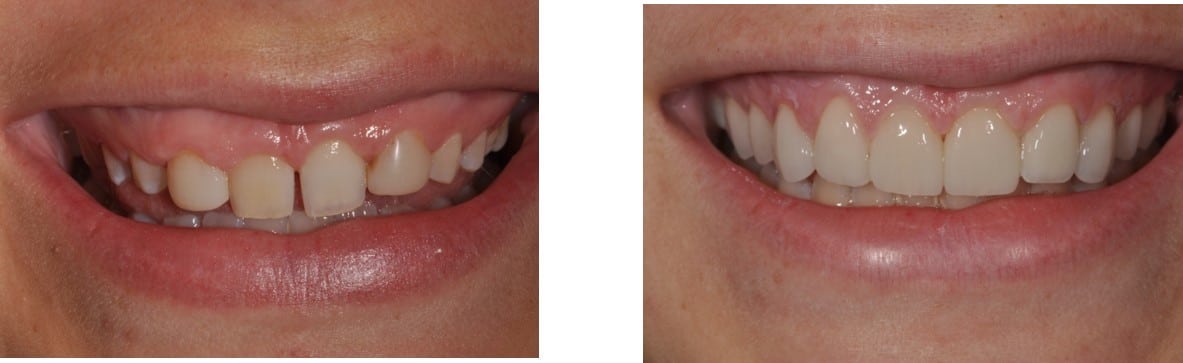 Before / After Veneers #18