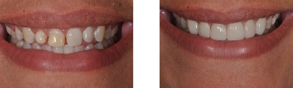 Before / After Veneers #2