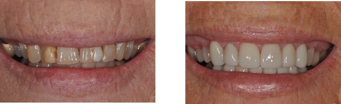 Before / After Veneers #3