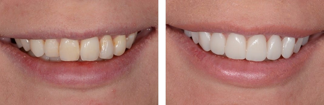 Before / After Veneers #4