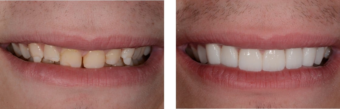 Before / After Veneers #5