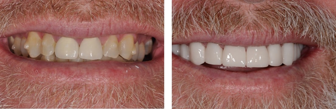 Before / After Veneers #6