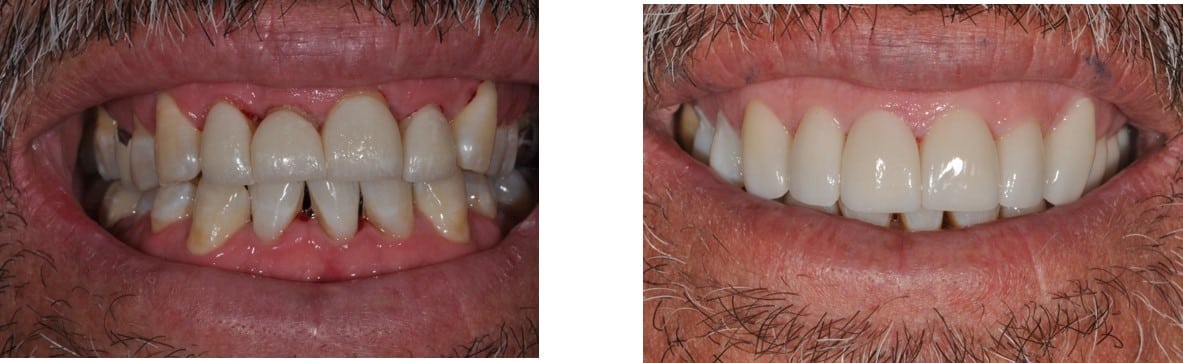 Before / After Veneers #7