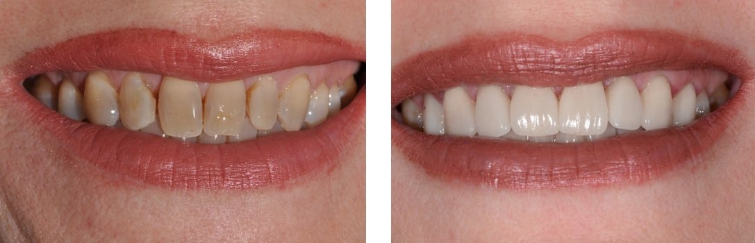 Before / After Veneers #8