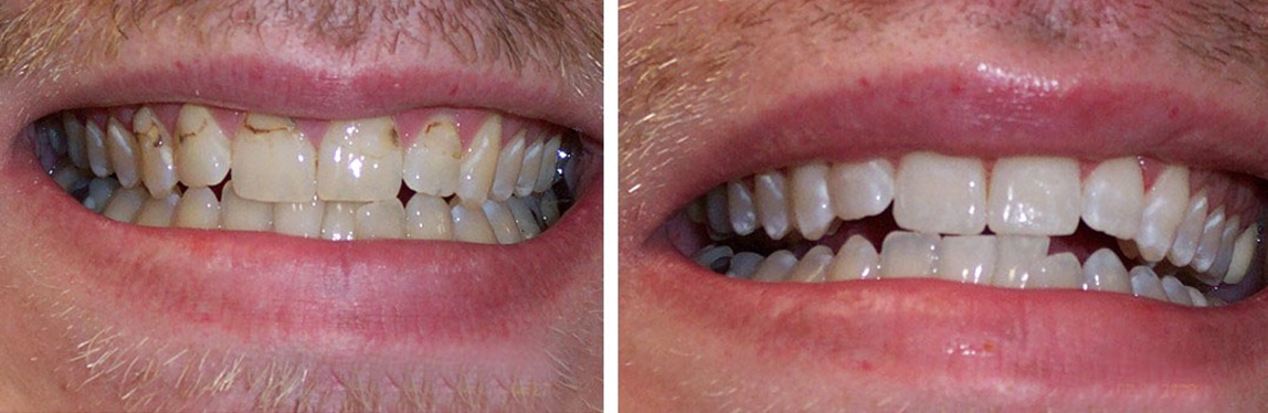 Before / After Whitening #1