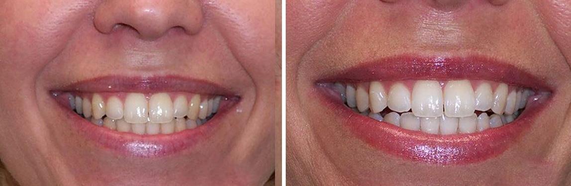 Before / After Whitening #2