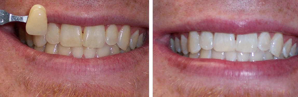 Before / After Whitening #3