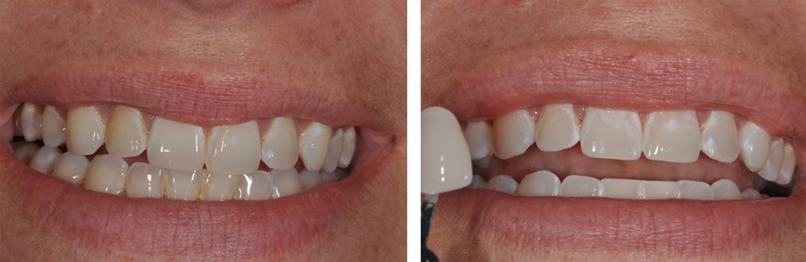 Before / After Whitening #4
