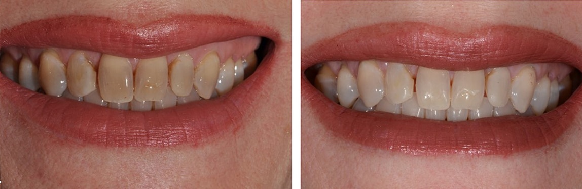 Before / After Whitening #5