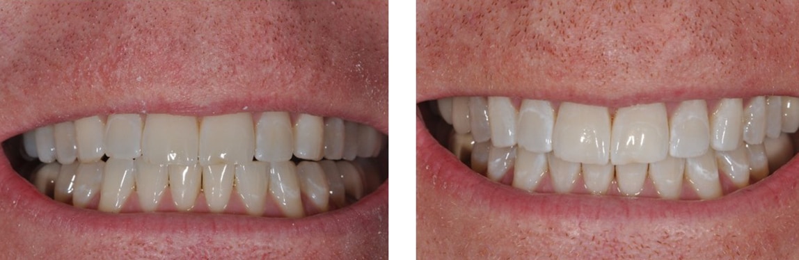 Before / After Whitening #6