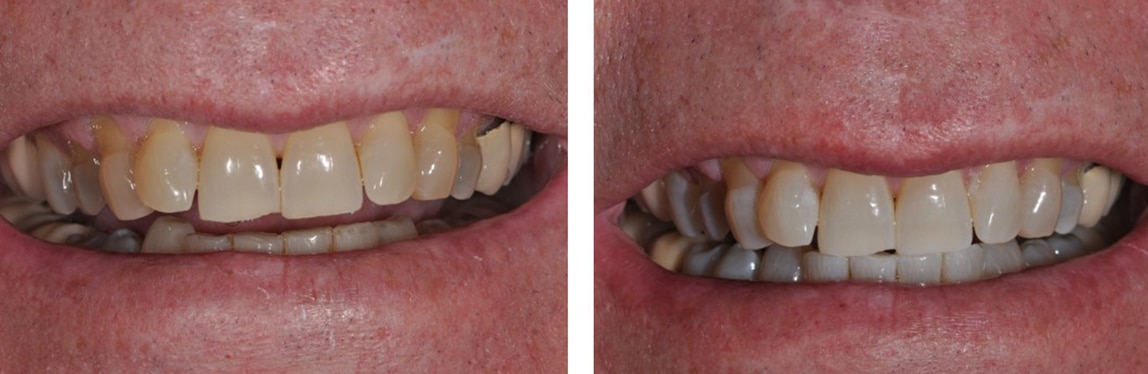 Before / After Whitening #7