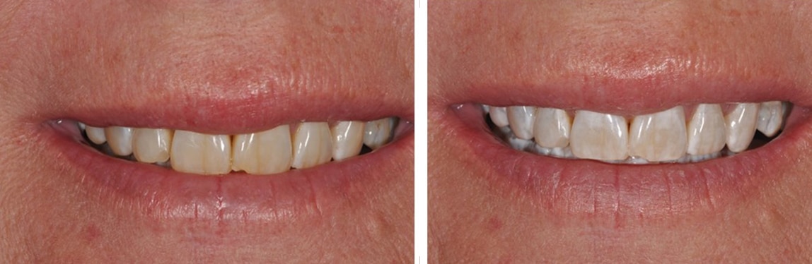 Before / After Whitening #8