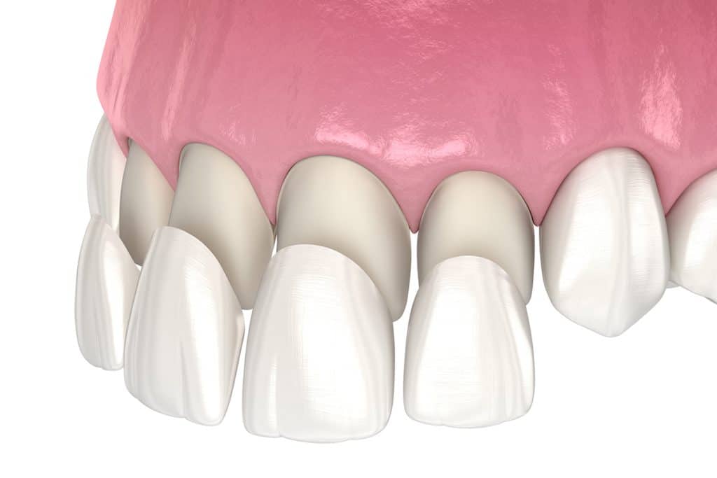 How Much Do Veneers Cost in Lubbock, TX?