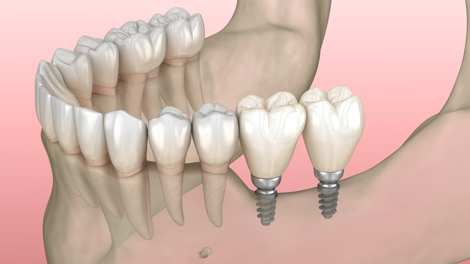 Mini Implant Illustration