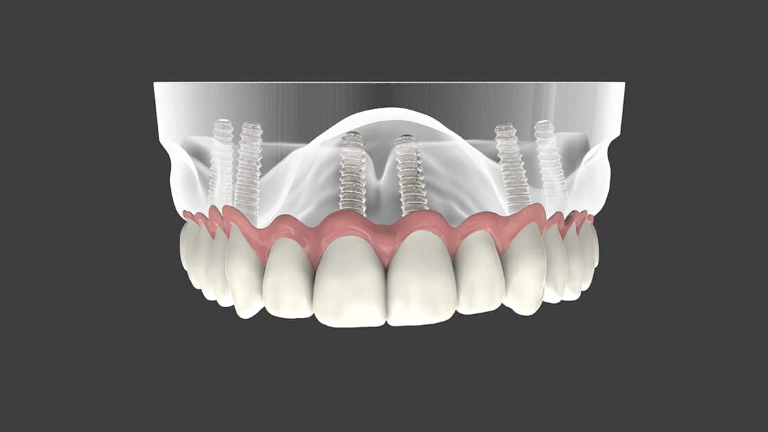 Full Arch Dental Implants Photo