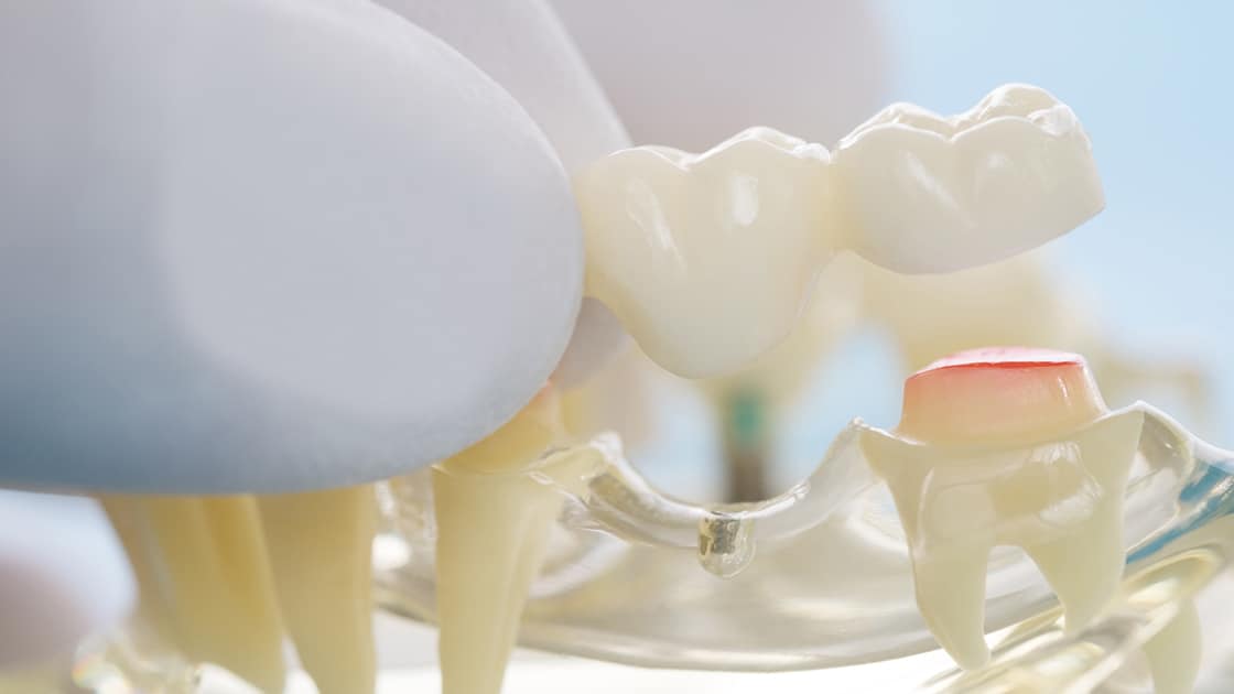 Dental Bridge Illustration