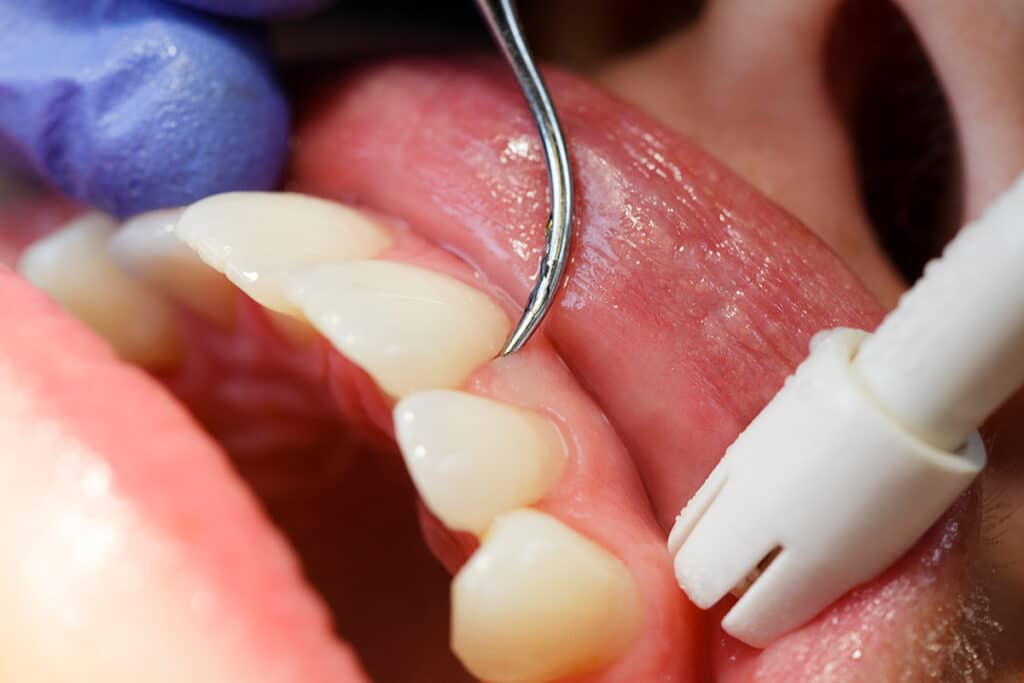 The Hidden Causes of Gum Disease: Are You at Risk?